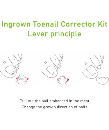 Ingrown Toenail Lifter Tool Ingrown Nail Corrector Professional Ingrown Toe Nail Correction Kit Pedicure Toes Treatment Tools Set for Paronychia - Buy Online on GoSupps.com