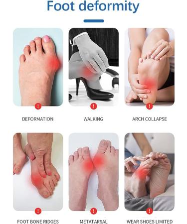 EITMOW Bunion Corrector for Women and Men - Orthopedic Bunion Toe Separators and Straightener for Day and Night Support - 2 Pair - Buy Online on GoSupps.com