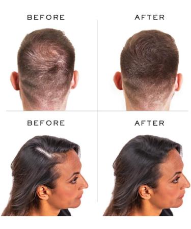 Nanogen Hair Fibres 15g Medium Brown - Pack of 1 | Natural Hair Thickening Solution - Buy Online on GoSupps.com