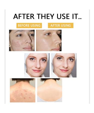 Kojic Acid Body Soap - Vegan Skin Soap for Uneven Skin Face & Body Care with Tea Tree & Coconut Oil - Buy Online on GoSupps.com