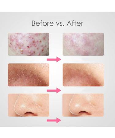 10-Piece Acne Needle Set - Blackhead Remover & Comedone Extractor Tools for Effective Acne Removal - Tweezers Kit for Clear Skin - Buy Online on GoSupps.com