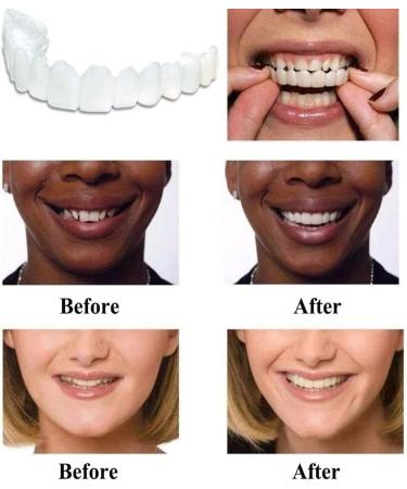 Flipped Warm Teeth Veneers Set - 2 Pairs for Immediate Cosmetic Brightening | International Shipping Available - Buy Online on GoSupps.com