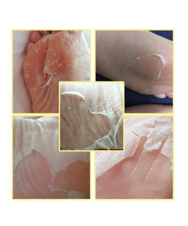 Shop Foot Peeling Mask - Effective Hard Skin Remover & Callus Treatment for Women | International Shipping Available - Buy Online on GoSupps.com
