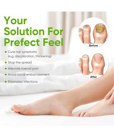 Blue Light Nail Repair Laser Treatment Device | Rechargeable Toenail & Fingernail Repair Kit - Buy Online on GoSupps.com