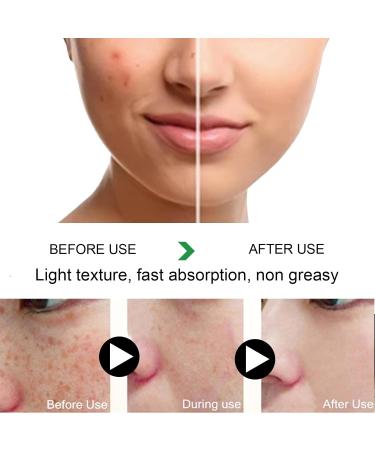 Age Spot Remover for Face Dark Spot Remover for Face & Body Spot Cream Dark Spot Corrector Freckle Remover Cream Dark Spot Correcting Glow Serum Dark Spots Remover Dark Spot Corrector Cream 20 g - Buy Online on GoSupps.com