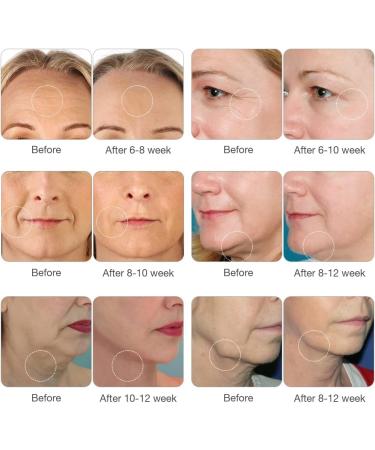 High-Tech RF Beauty Instrument - Skin Tightening Device for Face and body | home RF lifing | Salon effects | Collagen Stimulation for Wrinkle Reduction Facial Lifting - Buy Online on GoSupps.com