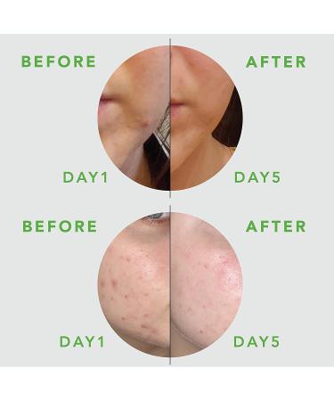Meebak Cica Acne Pimple Patch for Face - 54 Count | Acne Spot Treatment for Blemishes and Zits - Buy Online on GoSupps.com