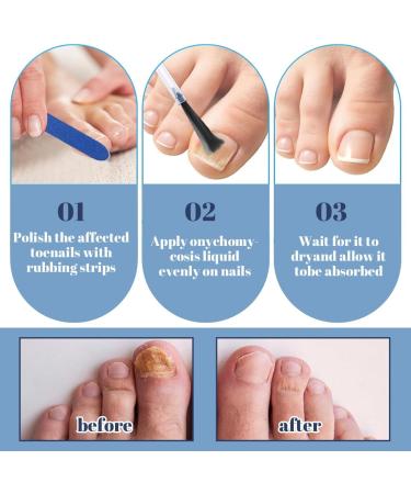 XPEX 30ml Foot Nail Repair Liquid Super Strong Nail Fungus Repair Solution For Repairing Nails And Toenails Protects Thick Damaged And Discolored Nails Includes Nail File - Buy Online on GoSupps.com