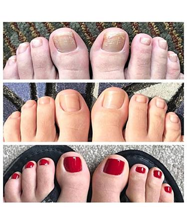Fungal Nail Eraser Toenail Treatment - Maximum Strength Antifungal Relief for Clear, Healthy Nails - Effective Against Infections - Repair Brittle Nails - Buy Online on GoSupps.com
