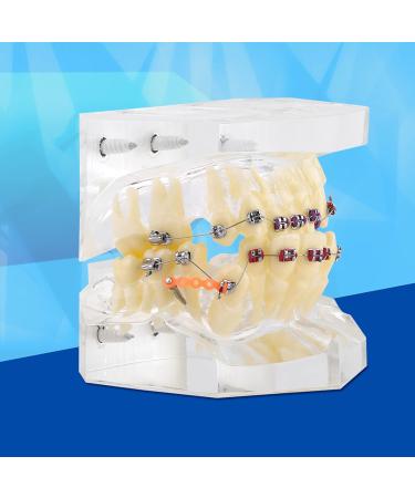 Orthodontic Treatment Weikeya Model | Harz Group PVC Teeth Learning - International Shipping Available - Buy Online on GoSupps.com
