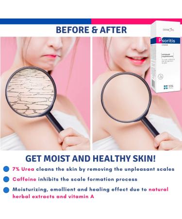 Psoritis 7% Urea Cream - Treat Eczema Keratosis & Psoriasis | Hydrate Dry Cracked Skin on Body Feet Elbows & Knees | Enriched with Caffeine & Vitamin A - Buy Online on GoSupps.com