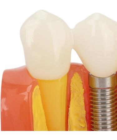 Verdant Touch Crown Bridge Demonstration Model - 4X Dental Implant Model for Doctor-Patient Education | International Shipping - Buy Online on GoSupps.com