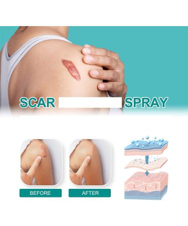 2pcs Advanced Scar Remove Spray & Cream Set (20g) - Physician Formulated Acne Scar Removal Gel | Moisturizing & Diminishing Results - Buy Online on GoSupps.com