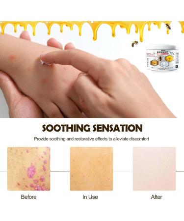 Buy Bee Venom Cream for Psoriasis & Warts - Natural Soothing Treatment Worldwide Shipping - Buy Online on GoSupps.com