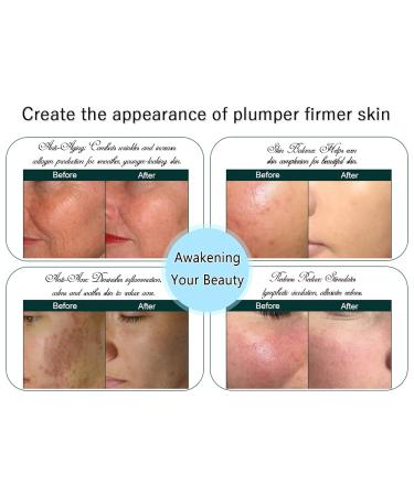 Professional Titanium Micro Needles Dermaroller 192 Pins - 0.5mm for Face, Skin, Hair Growth - Buy Online on GoSupps.com