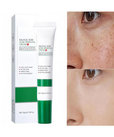 Salicylic Acid Acne Treatment Dark Spot Remover for Face - Crema Para Manchas Oscuras En La Cara Crema Blanqueadora Para La Cara Cremas Para Quitar Manchas De La Cara 1 Pack