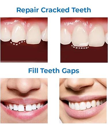 Temporary Tooth Filling Repair Kit - Dental Tooth Filler for Missing or Broken Teeth - Buy Online on GoSupps.com