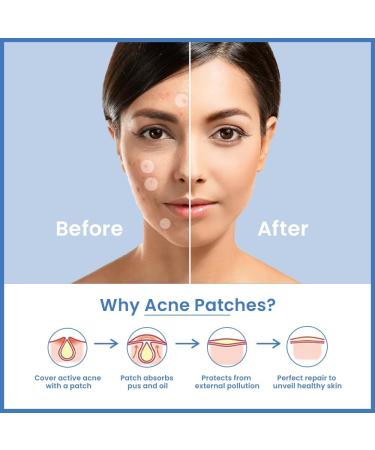 Loom Heavens Invisible Spot Shield- 72 Hydrocolloid Pimple Patches with Salicylic Acid & Camellia Leaf's Extract-Fast-Acting Acne Patches Spot Patches for Acne Scar Treatment and best Acne Skin Care. - Buy Online on GoSupps.com