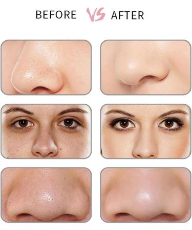 USB Charged Blackhead Removal Tool Pore Cleaning Blackhead Extractor Device - Buy Online on GoSupps.com