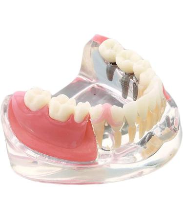 Dental Restoration Model With 3 Implants Overdenture Inferior Teaching Study Teeth Model Teaching Study Teeth Replica of