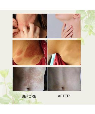 LDZJHTYY Natural Anti Itch Cream - Relief for Itchy Skin, Redness, Dermatitis & Eczema - 4pcs - Buy Online on GoSupps.com