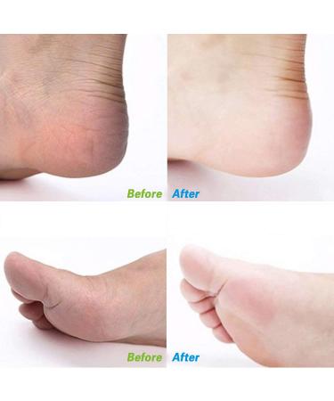 Foot File Callus Remover Surgical Steel Dual-Sided Foot Rasp Pedicure for Feet Care Hard Skin Remove - Buy Online on GoSupps.com