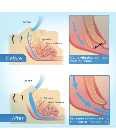 Buy Sno-Stopper Anti-Snoring Nasal Spreader | Stop Snoring for Better Sleep | 2 Styles 4 Sizes Available | International Shipping - Buy Online on GoSupps.com