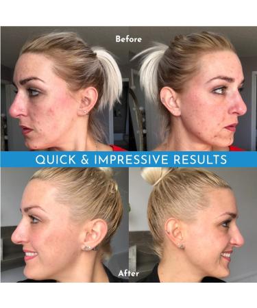 Truly Clear Acne Bar: Alcohol-Free Face & Body Cleanser with Hyaluronic Acid - Non-Drying Acne Treatment for Face, Chest, Butt, and Back - Buy Online on GoSupps.com