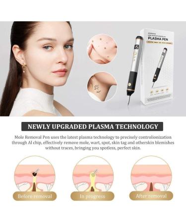  HpLNDas 15-Level Plasma Laser Pen for the Removal of Warts Moles Spots Freckles and Nevi on the Lips Hands Eyes Face Head and Nose Safe and Painless - Buy Online on GoSupps.com