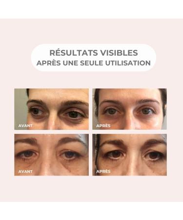 Patchs pour les yeux aux Micro-aiguilles Anti-poches Anti-rides Anti- ge Anti-Cernes Repulpant | Effet lissant imm diat | Peau Rajeunie | Acide Hyaluronique | Peptides | 1 paire - Buy Online on GoSupps.com