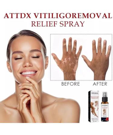 Alkyne Vitiligo Removal Relief Spray - Skin Repair & Treatment for Vitiligo Care (1pc) - Buy Online on GoSupps.com
