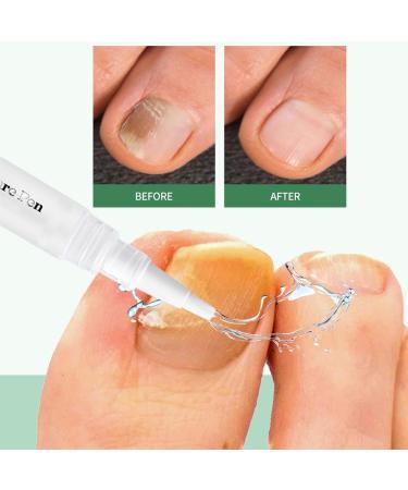 Nail Care Pen Lot de 3 Stylo de Soins Ongles pour Hydrater et Renforcer les Ongles Gardez les Ongles des Mains et des Pieds Propres avec l'aloe vera l'huile d'arbre th Vitamine E Stylo de Soins Ongles #A - Buy Online on GoSupps.com