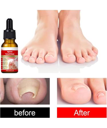  Qfdiwr Nail and Toenail Strengthening Liquid - 10ml Ingrown Toenail Corrector Drops - Beauty Care for Hands and Feet - Night Travel Treatment for Dry Damaged Cracked Curved Fragile and Chipped Nails - Buy Online on GoSupps.com