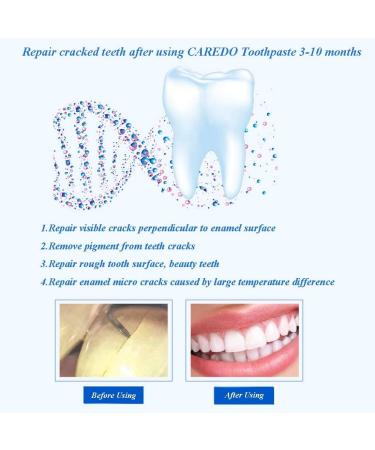 CAREDO Healing Teeth Crack Toothpaste - Repair Cracked Enamel, Cure Sensitivity, Remove Pigment - 100g (Pack of 2) - Buy Online on GoSupps.com
