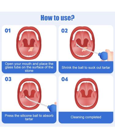Riisoyu Almond Stone Remover Tools - Tonsil Cline Cupping Glass with Suction Pipette for Fresh Breath & Oral Care - Buy Online on GoSupps.com