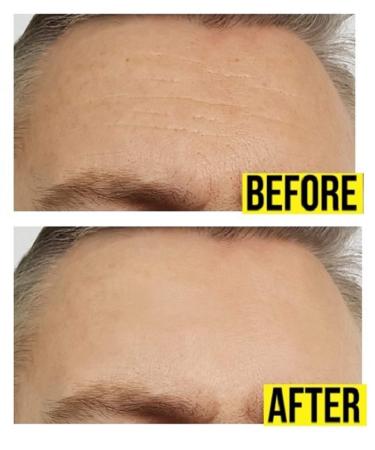 Hoosh Face Wrinkle Pads | 6 Pack Reusable Silicone Patches for Men & Women - Face Lift Mask for Neck, Forehead, Eyes, and Smile Lines Treatment - Buy Online on GoSupps.com