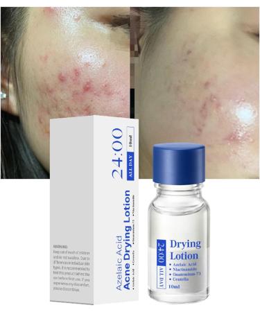 Spot Lotion 10 ml Drying Solution for Spots and Moisturizers | Fast-Acting Liquid for Facial Blemishes for Women for Daily and Nighttime Use Travel and - Buy Online on GoSupps.com