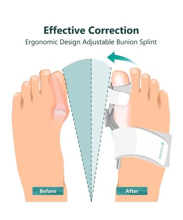 Bunion Corrector for Women Men - Adjustable Splint for Bunion Relief with Toe Separators - Orthopedic Toe Straightener Set - 2 Pairs Silicone Straighteners - 3 Pairs Spacer Included - Buy Online on GoSupps.com