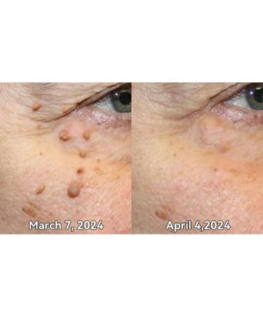 FROPUN Bee Venom Removal Cream - 100% Natural Fast-Acting Repair Cream for Adults - Maximum Strength Skin Care for Men & Women (1 Floz - Buy Online on GoSupps.com