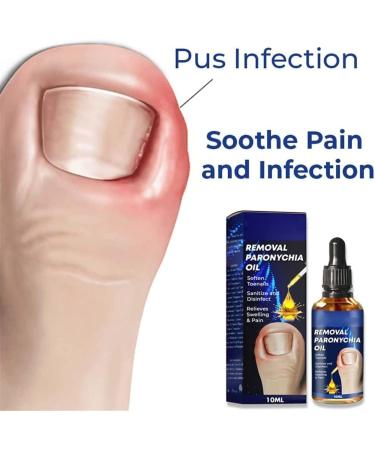 German Toenailcare Removal Paronychia Oil Care Oil for Removing Paronychia Toenail Treatment Best Nail Repair Solution Nail Renewal Liquid for Damaged & Discoloration Nail (3pcs) - Buy Online on GoSupps.com