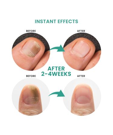 Extra Strength Toenail Treatment - Nail Renewal Repair Solution for Thick Broken & Discolored Nails (1oz) | International Shipping - Buy Online on GoSupps.com