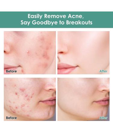 Cystic Acne Treatment: Effective Hormonal Acne Cream for Face | Acne Treatment - Buy Online on GoSupps.com
