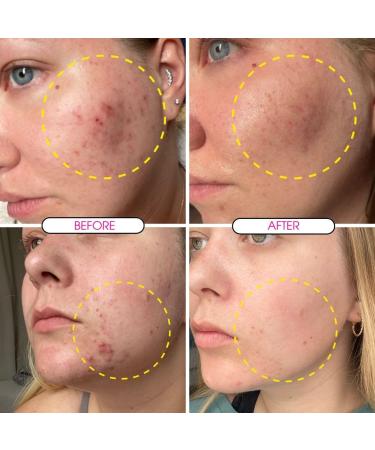 Clear Skin Days Clarifying Face Cleanser with 2% Salicylic & 2% Glycolic Acid - Deep Cleans Exfoliates Reduces Oil Unclog Pores and Resurface Skin- Perfect For Acne-Prone Skin 150ml - Buy Online on GoSupps.com