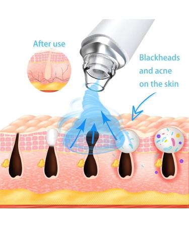 Electric Blackhead Remover with Camera Visual Electric Facial Pore Cleaner Phone Linked Display WiFi Beauty Device for Skin Care Powerful Removal Blackhead Acne Extractor with 6 Replaceable Probes - Buy Online on GoSupps.com