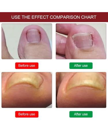 Ingrow Toenail Correction Treatment Oil Ingrown Toenail Correction Drops Cuticle Care Oils for Ingrown Toenails Nail Care and Treatment Ingrown Toenail Drops Ingrowing Toenail Treatment 10ML - Buy Online on GoSupps.com