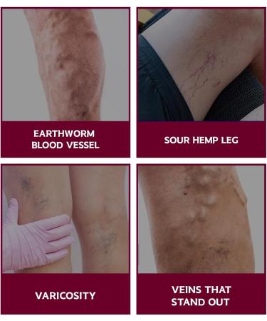  Joittey Algae Ointment for Legs Algae Ointment Active Algae Cream for Varicose Veins Algae Ointment Soothes and Rels Swollen Legs Suitable for All Skin Types - Buy Online on GoSupps.com
