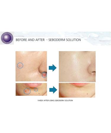 Buy Acne Seboderm Solution - Anti Sebum Treatment for Blemish-Prone Skin | Pore Shrinking Care Worldwide Shipping - Buy Online on GoSupps.com