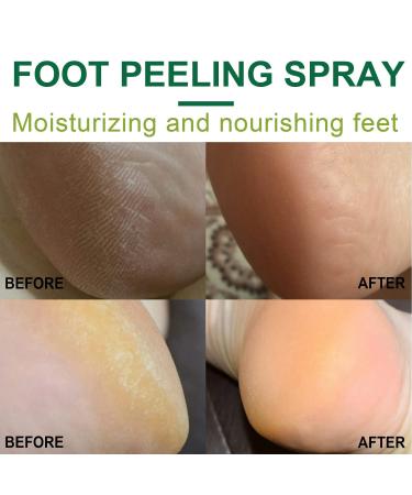 Orange Oil Foot Peeling Spray - Remove Dead Skin & Calluses in Seconds - Hydrating Exfoliating Spray (30ml) - Buy Online on GoSupps.com