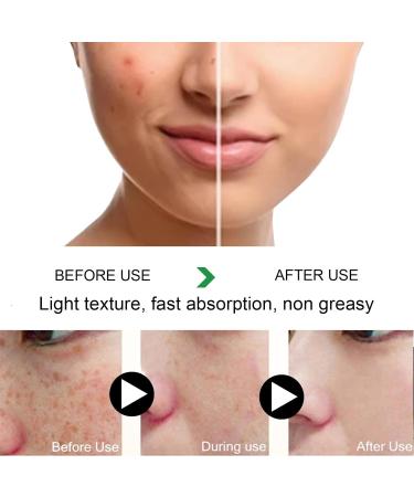 RESOVTE Cremas Para Manchas En La Cara Cream Skin Tone Imperfections Care Cremas Para Quitar Manchas De La Cara Crema Para Manchas En La Cara Crema Para Las Manchas De La Cara (5PCS) - Buy Online on GoSupps.com