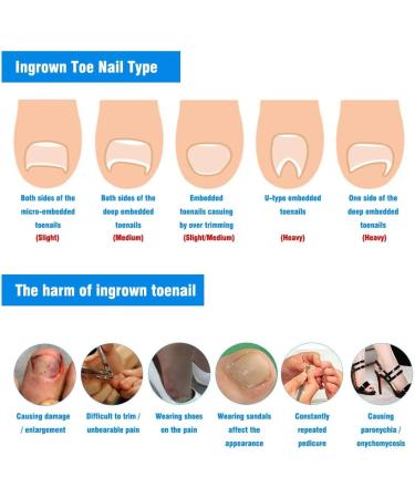 10Pcs/Box Toenail Correction Ingrown Sticker Patch Toe Nail Fixer Recover Pedicure Tool Super Thin Design for Comfort Strong Toughness Effective Corrector Suitable for - Buy Online on GoSupps.com